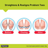 Flex-Tastic Toe Relaxers Toe Relaxer Profoot   
