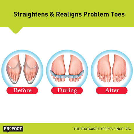Flex-Tastic Toe Relaxers Toe Relaxer Profoot   